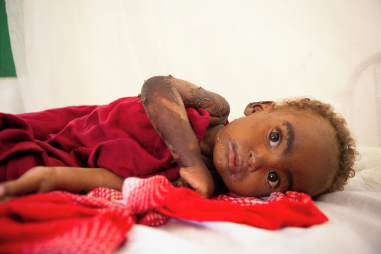 La storia di Halima: la bambina prima del trattamento